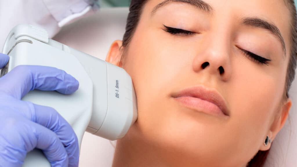 Lifting facial con HIFU