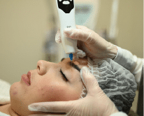 FIBROBLAST PLASMA PEN