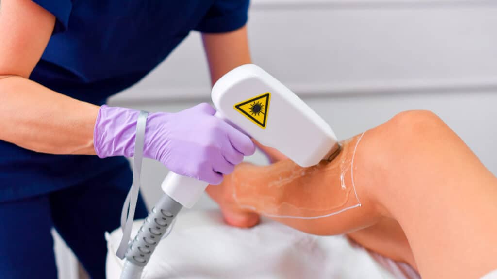 fotodepilación-láser