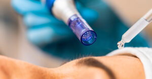 Microneedling-o-Nanosoft