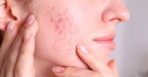 acne