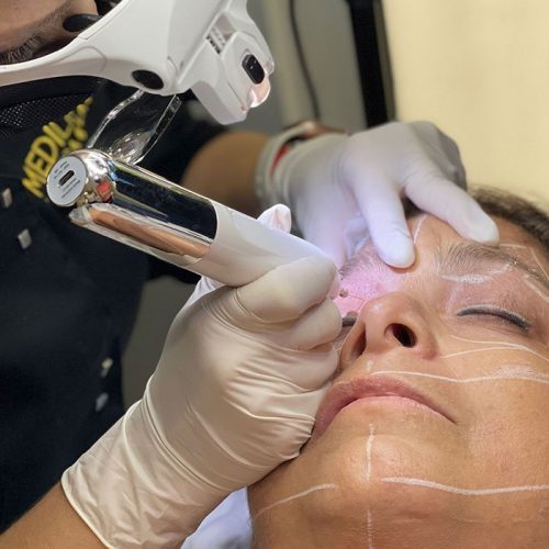 FIBROBLAST-CURSO FIBROBLAST-CURSO